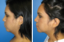 Before & After Photos